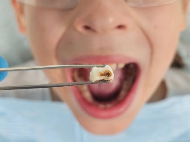 Best Emergency Wisdom Teeth Removal in Guyton, GA